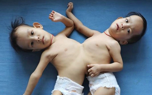 Surgery To Separate Bhutanese Conjoined Twins Postponed
