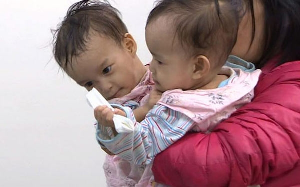 Conjoined Twins From Bhutan To Be Separated On Friday